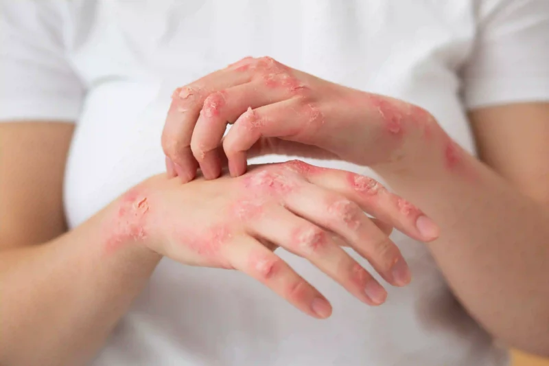 Plaques rouges de psoriasis sur les mains avec squames blanches caractéristiques de la maladie inflammatoire cutanée